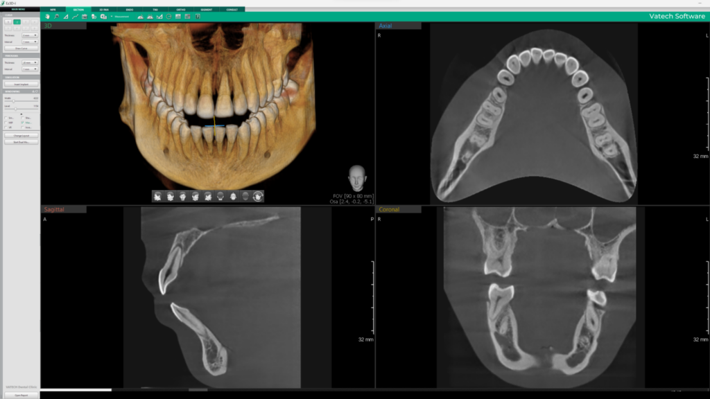Vatech Web [Function A9 FOV 2 preview]