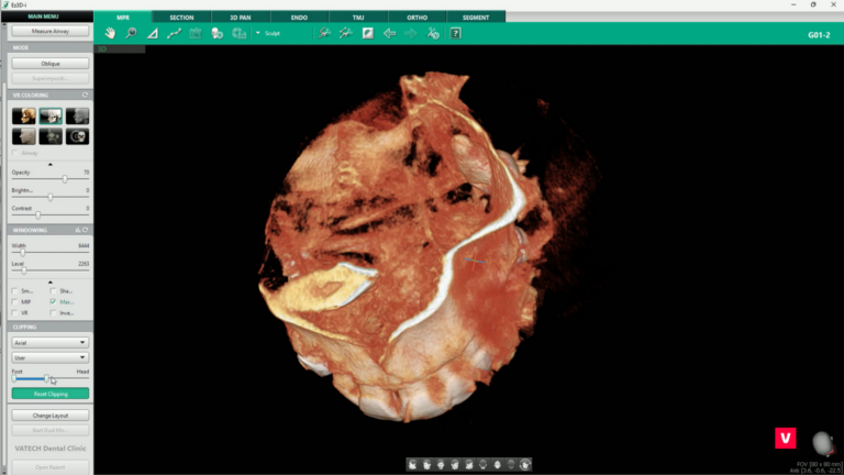 Tooth in Maxila CBCT image