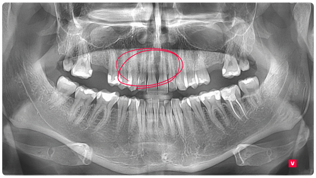 Tooth 11 Fracture