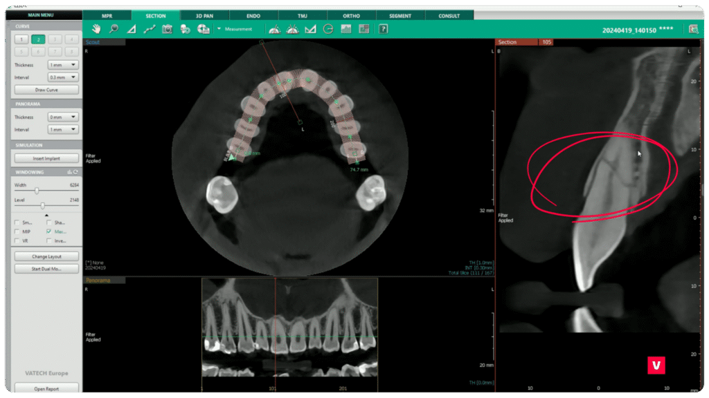 Tooth 11 Fracture CBCT Image