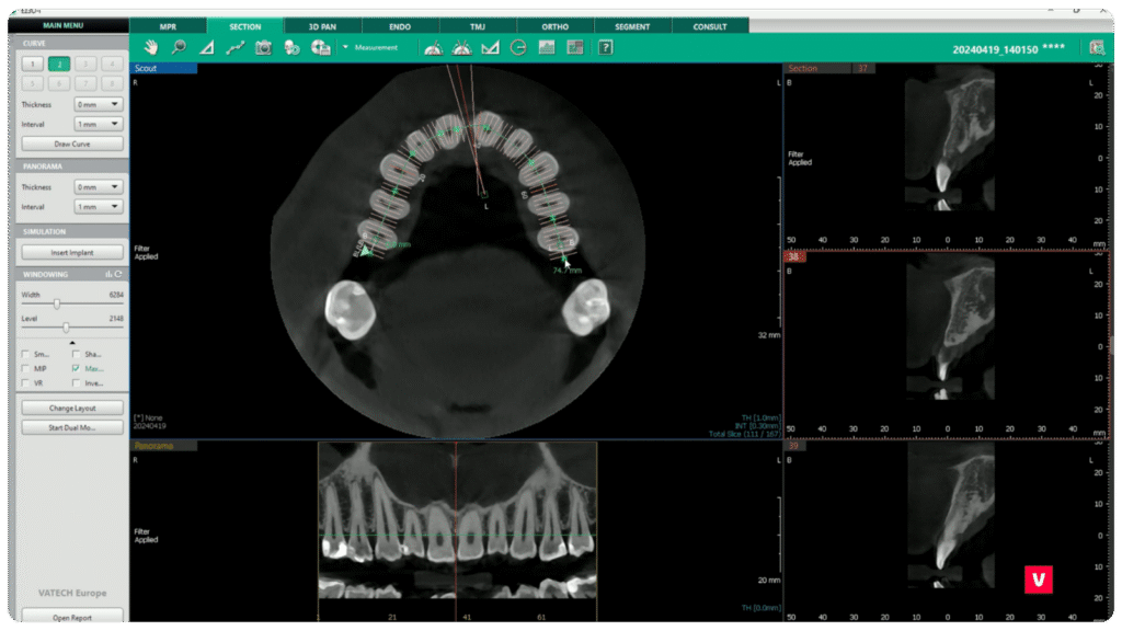 Tooth 11 Fracture CBCT Image