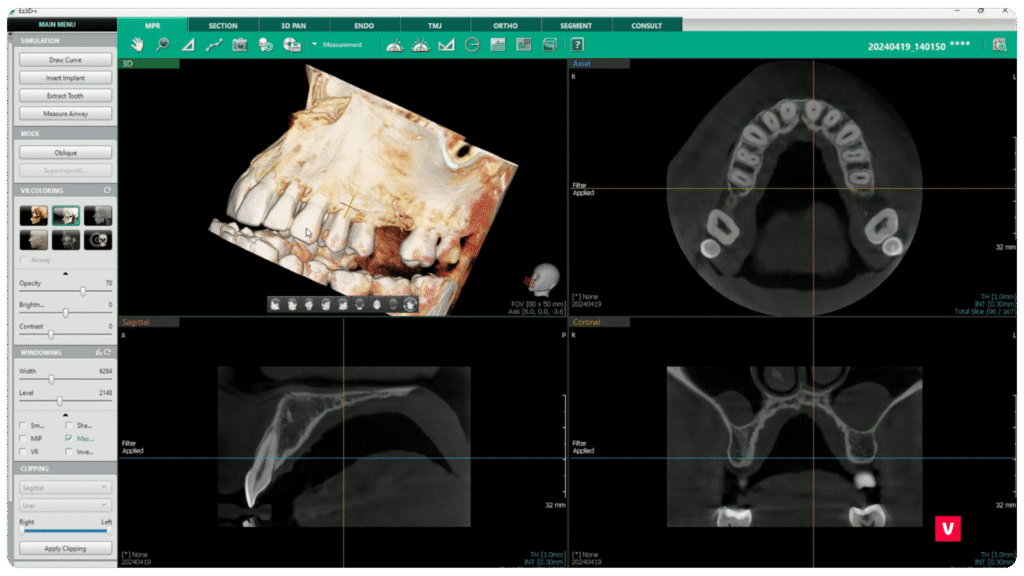 Tooth 11 Fracture CBCT Image