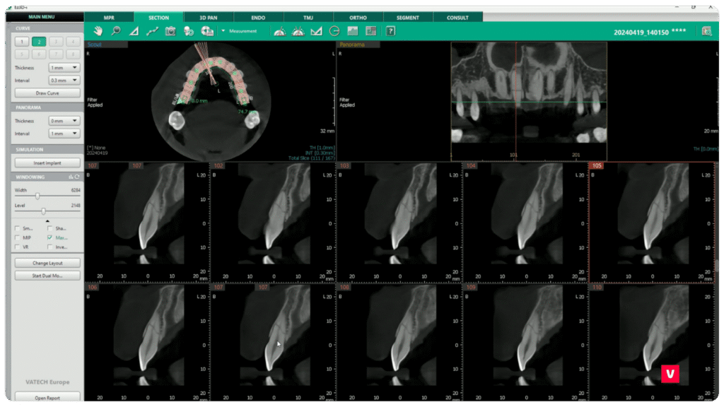 Tooth 11 Fracture CBCT Image