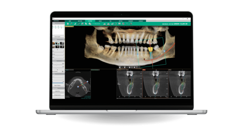 Mandibular Canal Drawing