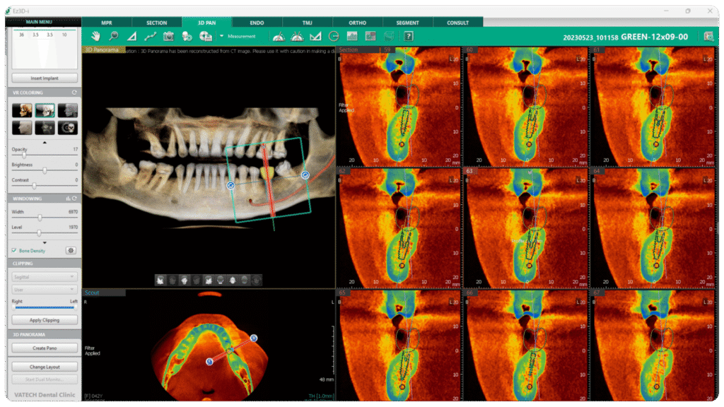 Bone Density Overlay