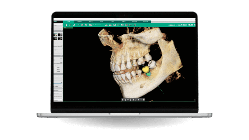 Implant Placement 3D