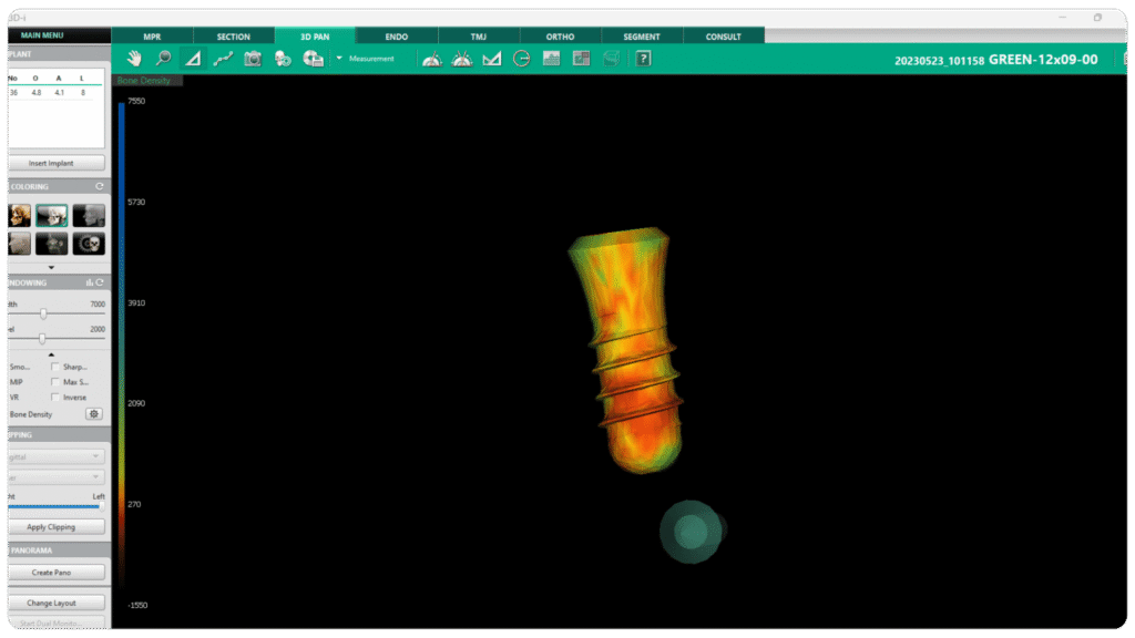 Bone density implant overlay