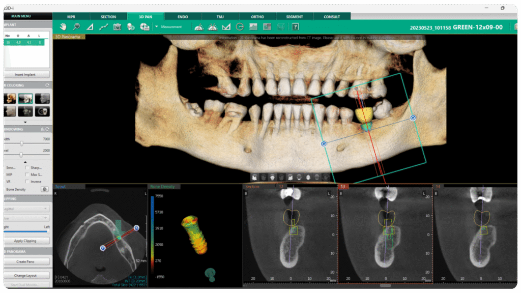 Bone density