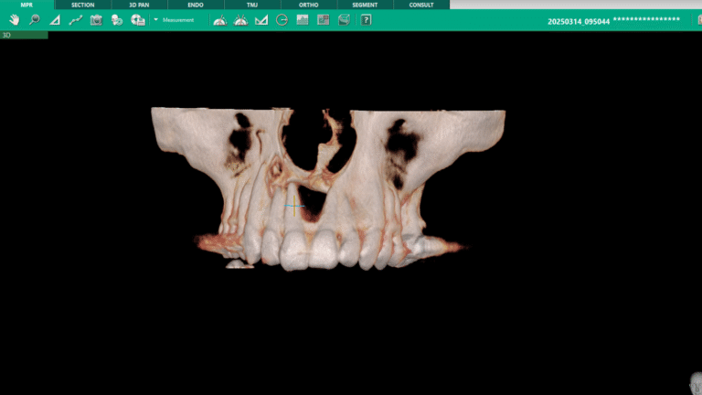 Radicular cyst